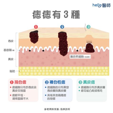 乳頭長痣|痣形成的原因？痣長毛、痣變多變大是痣病變？5招判別